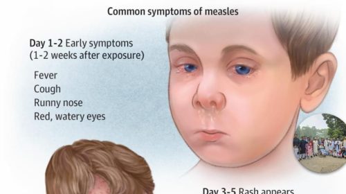 দেশের বিভিন্ন অঞ্চলে হাম রোগে আক্রান্ত হয়ে শিশু মৃত্যুর খবর বাড়তে থাকায় জনমনে উদ্বেগ দেখা দিয়েছে। স্বাস্থ্য বিশেষজ্ঞরা বলছেন, শুরুতে সাধারণ জ্বর-ঠান্ডা ভেবে অবহেলা করা এবং সময়মতো টিকা না নেওয়াই পরিস্থিতিকে জটিল করে তুলছে। হাম একটি অত্যন্ত সংক্রামক ভাইরাসজনিত রোগ। রোগের প্রাথমিক লক্ষণ হিসেবে প্রথম ৩-৪ দিন জ্বর, নাক দিয়ে পানি পড়া, কাশি এবং চোখ লাল হওয়া দেখা যায়। এ সময় রোগটি সাধারণ সর্দি-কাশি মনে হওয়ায় অনেকেই বিষয়টি গুরুত্ব দেন না। তবে মুখের ভেতরে গালের পাশে ছোট সাদা দানার মতো দাগ—যাকে Koplik’s Spots বলা হয়—হাম শনাক্তের একটি গুরুত্বপূর্ণ লক্ষণ হিসেবে বিবেচিত। এরপর ১-২ দিনের মধ্যে শরীরে লালচে র‍্যাশ দেখা দেয়, যা সাধারণত কান থেকে শুরু হয়ে মুখ ও শরীরের নিচের দিকে ছড়িয়ে পড়ে। র‍্যাশ পুরো শরীরে ছড়িয়ে পড়ার সময় জ্বর অনেক বেড়ে যেতে পারে, যা কখনো কখনো ১০৪ ডিগ্রি ফারেনহাইট পর্যন্ত পৌঁছায়। চিকিৎসকদের মতে, হাম সাধারণত ৭ থেকে ১০ দিনের মধ্যে সেরে গেলেও কিছু ক্ষেত্রে মারাত্মক জটিলতা দেখা দিতে পারে। বিশেষ করে র‍্যাশ ওঠার পরও জ্বর না কমা বা আবার বেড়ে যাওয়া নিউমোনিয়ার লক্ষণ হতে পারে। এছাড়া শ্বাসকষ্ট, অস্বাভাবিক ঘুম, খিঁচুনি, চোখে অতিরিক্ত লালভাব, কান ব্যথা বা কান দিয়ে পানি পড়া এবং শিশুর পানি গ্রহণ কমে যাওয়া—এসব লক্ষণ দেখা দিলে দ্রুত হাসপাতালে নেওয়া জরুরি। বিশেষজ্ঞরা আরও জানান, হাম শরীরের রোগ প্রতিরোধ ব্যবস্থাকে দুর্বল করে দেয়। ফলে আক্রান্ত শিশু সুস্থ হওয়ার পরও দীর্ঘ সময় অন্য রোগে আক্রান্ত হওয়ার ঝুঁকিতে থাকে, যা চিকিৎসাবিজ্ঞানে “ইমিউন অ্যামনেশিয়া” নামে পরিচিত। হামের নির্দিষ্ট কোনো অ্যান্টিভাইরাল চিকিৎসা নেই। সাধারণত ভিটামিন এ, জ্বর নিয়ন্ত্রণে প্যারাসিটামল এবং পর্যাপ্ত পানি ও বিশ্রামের মাধ্যমে চিকিৎসা দেওয়া হয়। তবে জটিলতা দেখা দিলে হাসপাতালে ভর্তি প্রয়োজন হতে পারে। স্বাস্থ্য বিশেষজ্ঞরা জোর দিয়ে বলছেন, হাম প্রতিরোধের সবচেয়ে কার্যকর উপায় হলো এমএমআর (MMR) টিকা গ্রহণ। জাতীয় টিকাদান কর্মসূচির আওতায় ৯ মাস বয়সে প্রথম ডোজ এবং ১৫ মাসে দ্বিতীয় ডোজ দেওয়া হয়, যা প্রায় ৯৭ শতাংশ পর্যন্ত কার্যকর। টিকা নিয়ে প্রচলিত ভুল ধারণা—বিশেষ করে “টিকা দিলে অটিজম হয়”—সম্পূর্ণ ভিত্তিহীন বলে জানিয়েছেন চিকিৎসকরা। এ সংক্রান্ত গবেষণা বহু আগেই ভুয়া প্রমাণিত হয়ে বাতিল হয়েছে। এ পরিস্থিতিতে অভিভাবকদের প্রতি আহ্বান জানানো হয়েছে, শিশুর টিকাদান সম্পন্ন হয়েছে কি না তা যাচাই করা এবং কোনো উপসর্গ দেখা দিলে দেরি না করে চিকিৎসকের শরণাপন্ন হওয়া। সচেতনতা বৃদ্ধি ও সময়মতো টিকা গ্রহণই পারে হামজনিত ঝুঁকি থেকে শিশুদের সুরক্ষিত রাখতে।