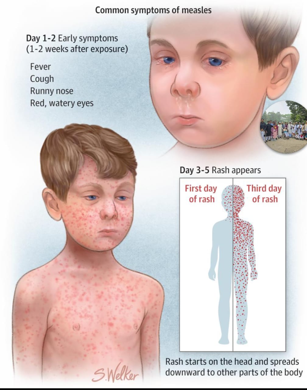 দেশের বিভিন্ন অঞ্চলে হাম রোগে আক্রান্ত হয়ে শিশু মৃত্যুর খবর বাড়তে থাকায় জনমনে উদ্বেগ দেখা দিয়েছে। স্বাস্থ্য বিশেষজ্ঞরা বলছেন, শুরুতে সাধারণ জ্বর-ঠান্ডা ভেবে অবহেলা করা এবং সময়মতো টিকা না নেওয়াই পরিস্থিতিকে জটিল করে তুলছে। হাম একটি অত্যন্ত সংক্রামক ভাইরাসজনিত রোগ। রোগের প্রাথমিক লক্ষণ হিসেবে প্রথম ৩-৪ দিন জ্বর, নাক দিয়ে পানি পড়া, কাশি এবং চোখ লাল হওয়া দেখা যায়। এ সময় রোগটি সাধারণ সর্দি-কাশি মনে হওয়ায় অনেকেই বিষয়টি গুরুত্ব দেন না। তবে মুখের ভেতরে গালের পাশে ছোট সাদা দানার মতো দাগ—যাকে Koplik’s Spots বলা হয়—হাম শনাক্তের একটি গুরুত্বপূর্ণ লক্ষণ হিসেবে বিবেচিত। এরপর ১-২ দিনের মধ্যে শরীরে লালচে র‍্যাশ দেখা দেয়, যা সাধারণত কান থেকে শুরু হয়ে মুখ ও শরীরের নিচের দিকে ছড়িয়ে পড়ে। র‍্যাশ পুরো শরীরে ছড়িয়ে পড়ার সময় জ্বর অনেক বেড়ে যেতে পারে, যা কখনো কখনো ১০৪ ডিগ্রি ফারেনহাইট পর্যন্ত পৌঁছায়। চিকিৎসকদের মতে, হাম সাধারণত ৭ থেকে ১০ দিনের মধ্যে সেরে গেলেও কিছু ক্ষেত্রে মারাত্মক জটিলতা দেখা দিতে পারে। বিশেষ করে র‍্যাশ ওঠার পরও জ্বর না কমা বা আবার বেড়ে যাওয়া নিউমোনিয়ার লক্ষণ হতে পারে। এছাড়া শ্বাসকষ্ট, অস্বাভাবিক ঘুম, খিঁচুনি, চোখে অতিরিক্ত লালভাব, কান ব্যথা বা কান দিয়ে পানি পড়া এবং শিশুর পানি গ্রহণ কমে যাওয়া—এসব লক্ষণ দেখা দিলে দ্রুত হাসপাতালে নেওয়া জরুরি। বিশেষজ্ঞরা আরও জানান, হাম শরীরের রোগ প্রতিরোধ ব্যবস্থাকে দুর্বল করে দেয়। ফলে আক্রান্ত শিশু সুস্থ হওয়ার পরও দীর্ঘ সময় অন্য রোগে আক্রান্ত হওয়ার ঝুঁকিতে থাকে, যা চিকিৎসাবিজ্ঞানে “ইমিউন অ্যামনেশিয়া” নামে পরিচিত। হামের নির্দিষ্ট কোনো অ্যান্টিভাইরাল চিকিৎসা নেই। সাধারণত ভিটামিন এ, জ্বর নিয়ন্ত্রণে প্যারাসিটামল এবং পর্যাপ্ত পানি ও বিশ্রামের মাধ্যমে চিকিৎসা দেওয়া হয়। তবে জটিলতা দেখা দিলে হাসপাতালে ভর্তি প্রয়োজন হতে পারে। স্বাস্থ্য বিশেষজ্ঞরা জোর দিয়ে বলছেন, হাম প্রতিরোধের সবচেয়ে কার্যকর উপায় হলো এমএমআর (MMR) টিকা গ্রহণ। জাতীয় টিকাদান কর্মসূচির আওতায় ৯ মাস বয়সে প্রথম ডোজ এবং ১৫ মাসে দ্বিতীয় ডোজ দেওয়া হয়, যা প্রায় ৯৭ শতাংশ পর্যন্ত কার্যকর। টিকা নিয়ে প্রচলিত ভুল ধারণা—বিশেষ করে “টিকা দিলে অটিজম হয়”—সম্পূর্ণ ভিত্তিহীন বলে জানিয়েছেন চিকিৎসকরা। এ সংক্রান্ত গবেষণা বহু আগেই ভুয়া প্রমাণিত হয়ে বাতিল হয়েছে। এ পরিস্থিতিতে অভিভাবকদের প্রতি আহ্বান জানানো হয়েছে, শিশুর টিকাদান সম্পন্ন হয়েছে কি না তা যাচাই করা এবং কোনো উপসর্গ দেখা দিলে দেরি না করে চিকিৎসকের শরণাপন্ন হওয়া। সচেতনতা বৃদ্ধি ও সময়মতো টিকা গ্রহণই পারে হামজনিত ঝুঁকি থেকে শিশুদের সুরক্ষিত রাখতে।